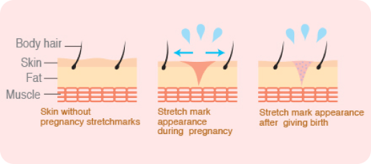 Illustration of pregnancy stretch marks
